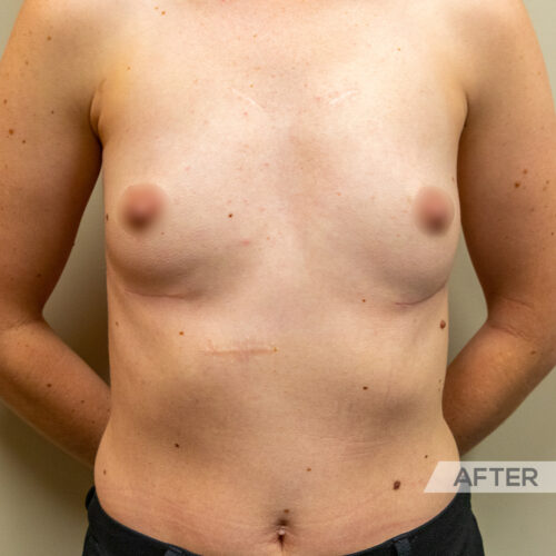 Breast Implant Removal, Explant Surgery Calgary