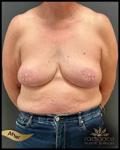 after breast reduction